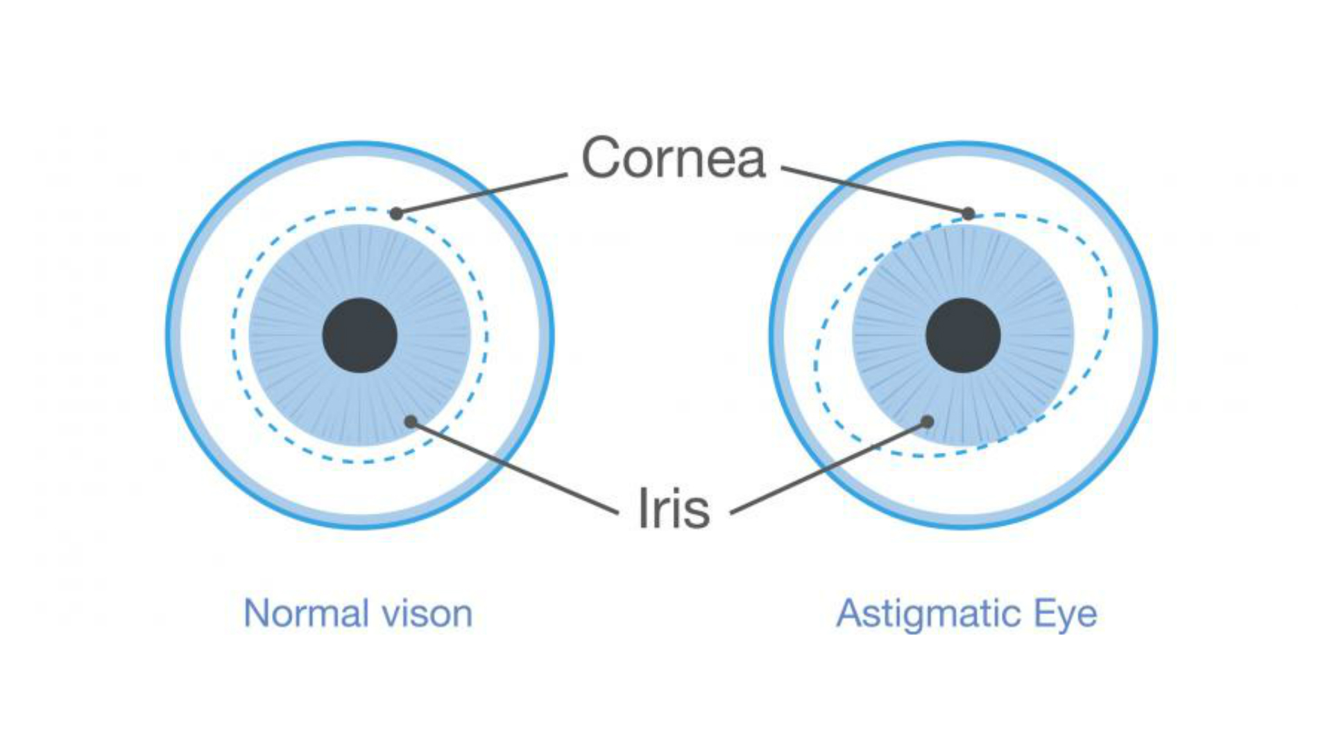 Astigmatism graphic showing difference between normal and astigmatic eye
