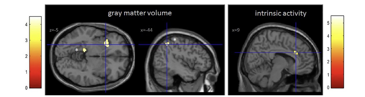 grey matter brain smartphone addiction