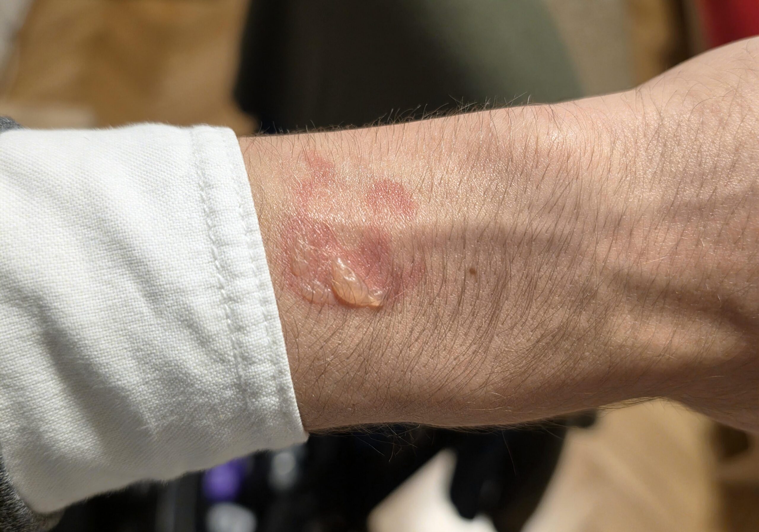 Galaxy Watch 5 Pro allegedly burning user Galaxy Watch 5 Pro allegedly burning user